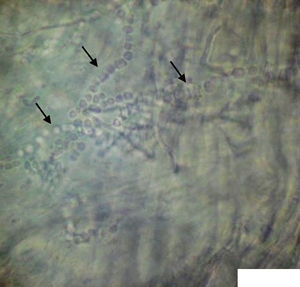 Imagen microscópica del examen directo: estructuras fibrilares con tabiques dispuestos a intervalos de distancia regular y con múltiples ramificaciones, que se correspondían con las hifas septadas características de los hongos dermatofitos.