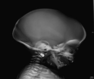 Aumento de la densidad ósea en la base del cráneo.