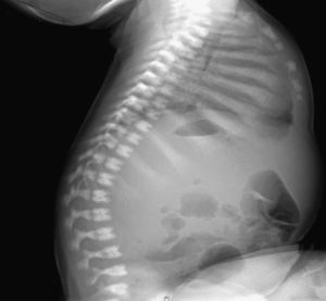 Esclerosis de costillas; imagen «hueso dentro de hueso» en los cuerpos vertebrales.