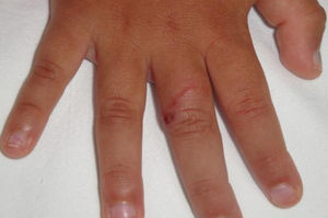 Lesión sobrelevada con costra impetiginizada en su porción más distal en dorso de tercer dedo de mano izquierda.