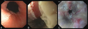 Lesiones endoscópicas observadas en tres pacientes. A) Grado 1: mucosa edematosa e hiperémica. B) Grado 2: ulceración y membranas no circunferenciales. C) Grado 3: múltiples ulceraciones y necrosis (áreas de coloración grisácea).