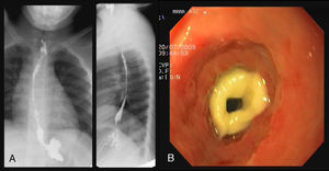Paciente con estenosis esofágica secundaria a esofagitis cáustica. A) Tránsito esófago-gastro-duodenal con contraste. B) Imagen endoscópica de estenosis cicatricial.