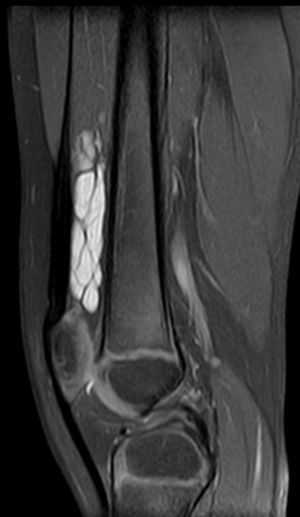 RM en plano sagital ponderado en DP-T2 con supresión grasa que muestra una lesión muy hiperintensa y con septos que ocupa la bursa suprarrotuliana.