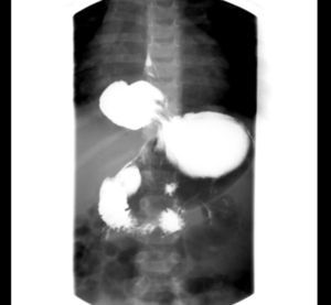 Tránsito esófago-gastro-duodenal en el que se observa la unión esofagogástrica por encima del diafragma y el fundus gástrico en el interior del hemitórax derecho.