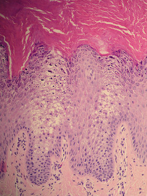En la imagen histológica se observa hiperqueratosis con acantosis, mostrando células epiteliales con citoplasmas disgregados y áreas claras, junto con gránulos de queratohialina (hematoxilina-eosina x40).