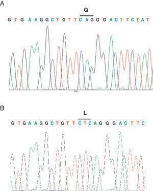 Análisis de secuencia del paciente (A) y de un control sano (B). Se muestra la mutación 3503_3504delTC del exón 19 de la paciente en estudio.