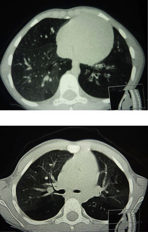 TCAR pulmonar en inspiración (superior) y en espiración (inferior). Cortes trasversales. Se observa patrón en mosaico bilateral con áreas de atrapamiento aéreo generalizado, tractos fibrosos centrales y periféricos y bronquiectasias.