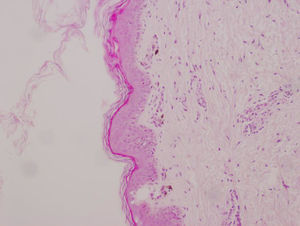 Biopsia de piel caso 1. Hiperqueratosis de tipo ortoqueratótico, sin alteración vacuolar de la capa basal y ausencia de pigmento melánico. Melanófagos en forma irregular en la dermis papilar.