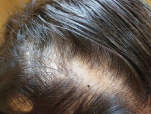 Alopecia areata en caso 4.