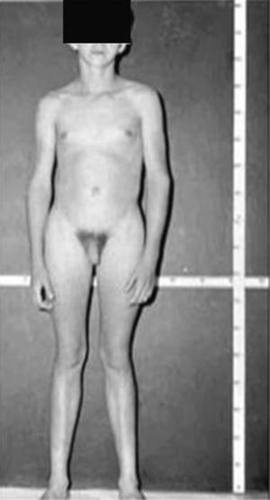 Varón de 15 años y 10 meses de edad con síndrome de Klinefelter, cariotipo 47,XXY, test pequeños y de consistencia firme, con ginecomastia y extremidades alargadas. Talla: 185cm.
