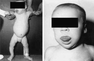 Paciente de 15 meses de edad con síndrome de Beckwith-Wiedemann. La talla es de 87,5cm y el peso de 14,6 Kg (ambos superiores al P95). La macroglosia es todavía evidente. No presentaba hipoglucemias.