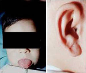 Paciente de 13 meses de edad con síndrome de Beckwith-Wiedemann. Nótese la macroglosia y lóbulo de la oreja arrugado.
