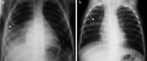 Rx de tórax AP de NAC con patrón bacteriano (A) y patrón vírico (B). A) Condensación basal derecha que borra hemidiafragma homolateral (signo de la silueta) preservando la línea paracardial, compatible con foco único de neumonía con patrón bacteriano en LID. Mínimo derrame pleural acompañante (flecha). B) Engrosamiento peribronquial bilateral en localización parahiliar junto a atelectasia segmentaria en LSD (flecha), con elevación de la cisura menor. Discreto atrapamiento aéreo bilateral (9 y 10 espacios intercostales derecho e izquierdo, respectivamente). Todo ello es compatible con neumonía con patrón viral.