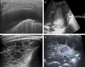 Estudio ecográfico del derrame y el parénquima pulmonar. A) Derrame pleural simple, ocupación del espacio pleural por líquido hipoecogénico, sin aparente presencia de septos o tabiques. No hay engrosamiento pleural. B) Derrame complicado de importante cuantía (aplana hemidiafragma, señalado con flecha y texto), con líquido ecogénico ocupando la cavidad pleural (DP) y engrosamiento mamelonado de la pleura (junto a la señalización del DP). Visualización del parénquima subyacente atelectasiado, homogéneo (P). C) Derrame complicado con septos y loculaciones, patrón en panal (c). D) Estudio ecográfico con Doppler color del parénquima subyacente a un derrame pleural complicado. Se evidencia el broncograma aéreo lineal, ecogénico (flecha) y la vascularización pulmonar, que en el caso mostrado, rodea a una zona redondeada hipoecogénica heterogénea compatible con foco de necrosis.