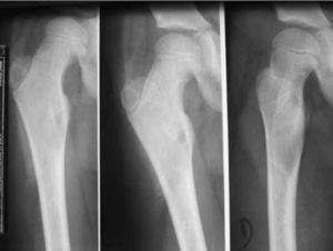 Radiografías antero-posteriores de fémur derecho (distintos ángulos) de niña de 7 años afectada de síndrome de McCune-Albright. Se puede apreciar una fractura patológica subtrocantérea sobre lesión típica de displasia fibrosa ósea (de unos 4×2cm).
