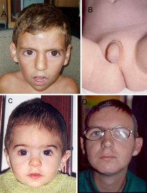 A y B Aspecto facial y genitales del paciente V-8. C Paciente V-9. D Paciente IV-33.