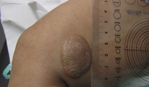 Lesión a los 3 meses del diagnóstico. Nódulo de 39 x 26mm de diámetro, sobreelevado, de coloración pardo-anaranjada en la cara externa de muslo izquierdo.