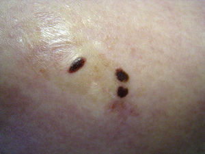 Varios nevus agminados. Previamente se había extirpado una lesión solitaria con las mismas características.