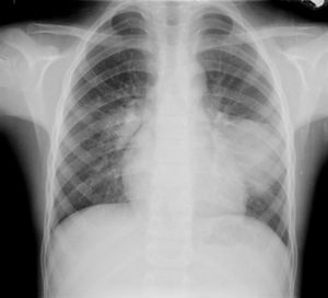 Radiografía simple de tórax proyección PA.