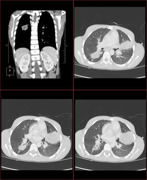 Imágenes obtenidas mediante tomografía computarizada: ventana pulmonar.