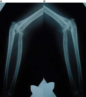 A, B) Radiografía de frente de ambos codos de la niña del caso 1. Se observa una subluxación radial proximal bilateral.