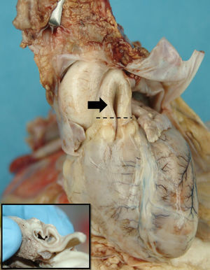 Visión frontal macroscópica del corazón del paciente. En él se visualiza el pliegue longitudinal situado en la raíz de la arteria pulmonar (flecha) y una sección transversal en la salida de la arteria pulmonar (recuadro inferior izquierdo).