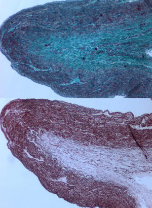 Tinción con tricrómico de Masson (imagen superior) y tinción específica de fibras elásticas (inferior) a la altura de la estenosis pulmonar. Se evidencia fibrosis colágena (superior) y disminución de fibras elásticas en la pared de la arteria pulmonar.