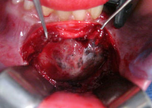 Imagen intraoperatoria de la lesión quística con el típico aspecto de cortical en «сáscara de huevo».