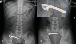 Radiografía de abdomen. A) Imanes formando un objeto único con pliegues de mucosa interpuesta entre ellos. Cadena metálica adyacente. B) A las 8 horas no se evidencia modificación.