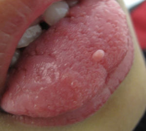 Fibroma traumático en el dorso de la lengua.