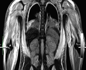 Resonancia nuclear magnética en secuencia STIR (short tau inversion recovery). Edema e inflamación difusa muscular, de la fascia y tejido subcutáneo en las extremidades superiores.