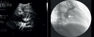 Ecocardiograma y coronariografía en los que se aprecia una importante dilatación de la coronaria izquierda-DEA (flechas finas blancas). Estrechamiento distal a nivel de la desembocadura en seno coronario (flecha gruesa blanca).