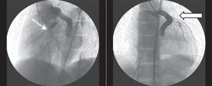 Coronariografías tras la oclusión definitiva con tapón vascular. Se aprecia la circunfleja (flecha fina blanca) y la DEA y sus ramas (flecha gruesa ancha) permeables. DEA: arteria descendente anterior.