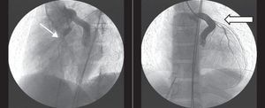 Coronariografías tras la oclusión definitiva con tapón vascular. Se aprecia la circunfleja (flecha fina blanca) y la DEA y sus ramas (flecha gruesa ancha) permeables. DEA: arteria descendente anterior.