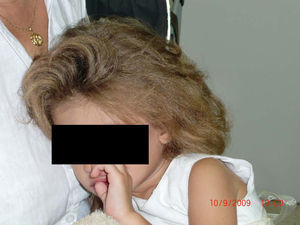 Niña con cabello color castaño claro, ralo.