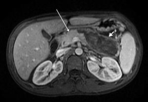 Corte axial T1 con contraste. Cabeza de páncreas normal (flecha fina). Extensa y severa afectación por pancreatitis en cuerpo y cola con falta de captación de contraste por probables cambios necróticos (flecha gruesa).