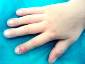 Acropaquias con panadizo en el 2.° dedo de la mano derecha.
