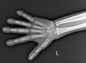 Acrosteólisis de la falange distal del 5.° dedo de ambas manos.