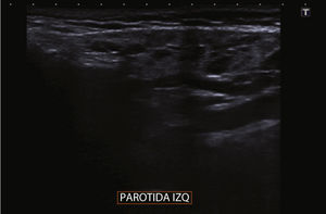 Ecoestructura alterada de la glándula parótida con múltiples quistes y adenopatías de pequeño tamaño.