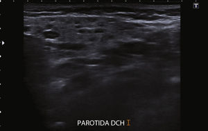 Múltiples lesiones nodulares bien delimitadas y de pequeño tamaño compatibles con parotiditis crónica recidivante.