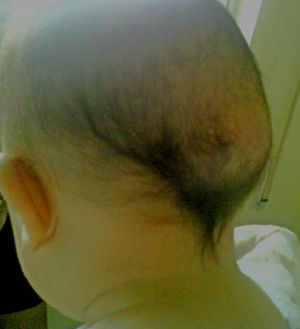 Tumor subcutáneo a nivel craneal, de consistencia pétrea.