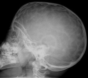 Radiografía de perfil de cráneo del paciente 2 mostrando impresiones digitales en los huesos del cráneo.