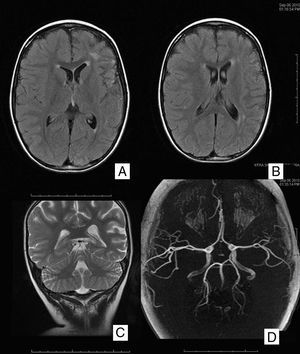 RM cerebral en secuencias potenciadas en T1 corte axial (A y B), T2 coronal (C) y secuencia vascular (D).