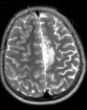 Imagen de RM (T2) corte axial. Lesión hiperintensa de gran tamaño en área parietal izquierda y atrofia de hemisferio cerebral izquierdo.