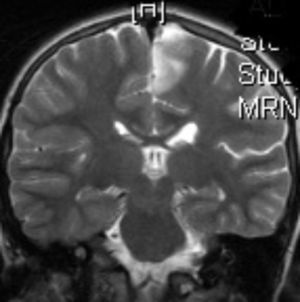 Imagen de RM (T2) corte coronal. Lesiones córtico-subcorticales a nivel frontal superior, frontal medio y parietal, de aspecto tumefactivo y atrofia marcada del hemisferio cerebral izquierdo.