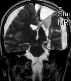 Imagen de RM (T2) corte coronal. RM de control tras hemisferectomía izquierda.
