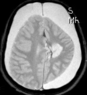 Imagen de RM (T2) corte axial. RM de control tras hemisferectomía izquierda.