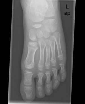Radiografía antero-posterior del pie izquierdo en la que se observa el hueso escafoides aumentado de densidad, con morfología en disco y fragmentación.