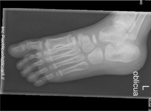 Radiografía oblicua del pie izquierdo en la que se aprecian los mismos hallazgos descritos en la figura 1.