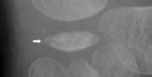 Detalle de la figura 1 en la que se aprecia el hueso escafoides aumentado de densidad con morfología en disco, esclerosis y fragmentación siguiendo un eje lineal. Hallazgos indicativos de necrosis aséptica.